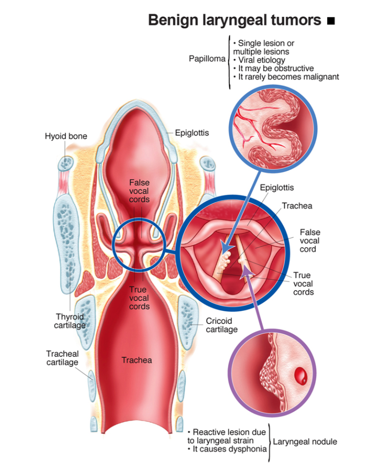 Infografis tumor jinak laring